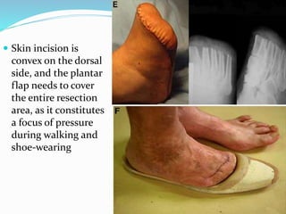  Skin incision is
convex on the dorsal
side, and the plantar
flap needs to cover
the entire resection
area, as it constitutes
a focus of pressure
during walking and
shoe-wearing
 