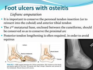 Foot ulcers with osteitis
Lisfranc amputation
 It is important to conserve the peroneal tendon insertion (or to
reinsert into the cuboid) and anterior tibial tendon
 The 2nd metatarsal base, enclosed between the cuneiforms, should
be conserved so as to conserve the proximal arc
 Posterior tendon lengthening is often required, in order to avoid
equinus
 