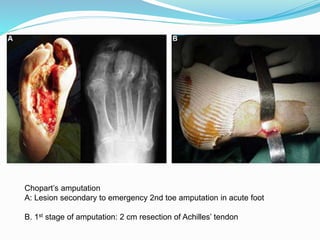 Chopart’s amputation
A: Lesion secondary to emergency 2nd toe amputation in acute foot
B. 1st stage of amputation: 2 cm resection of Achilles’ tendon
 