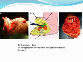 C. Amputation flaps
D. Tenoplasty of anterior tibial and peroneus brevis
tendons
 