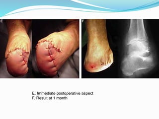 E. Immediate postoperative aspect
F. Result at 1 month
 