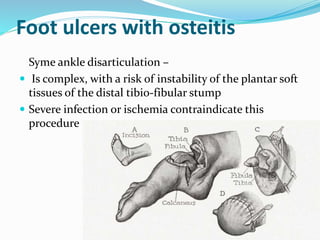 Foot ulcers with osteitis
Syme ankle disarticulation –
 Is complex, with a risk of instability of the plantar soft
tissues of the distal tibio-fibular stump
 Severe infection or ischemia contraindicate this
procedure
 