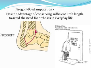 Pirogoff-Boyd amputation -
Has the advantage of conserving sufficient limb length
to avoid the need for orthoses in everyday life
 