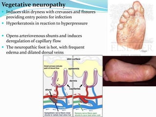 Vegetative neuropathy
 Induces skin dryness with crevasses and fissures
providing entry points for infection
 Hyperkeratosis in reaction to hyperpressure
 Opens arteriovenous shunts and induces
deregulation of capillary flow
 The neuropathic foot is hot, with frequent
edema and dilated dorsal veins
 
