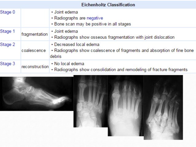Diabetic foot vinay 1