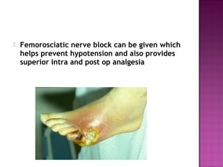    Femorosciatic nerve block can be given which
    helps prevent hypotension and also provides
    superior intra and post op analgesia
 