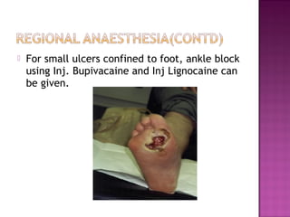    For small ulcers confined to foot, ankle block
    using Inj. Bupivacaine and Inj Lignocaine can
    be given.
 