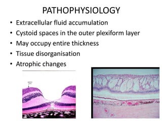 PATHOPHYSIOLOGY
•
•
•
•
•

Extracellular fluid accumulation
Cystoid spaces in the outer plexiform layer
May occupy entire thickness
Tissue disorganisation
Atrophic changes

 