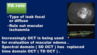 FA role
• Type of leak focal
or diffuse
• Rule out macular
ischaemia
Increasingly OCT is being used
for evaluation of macular edema .
Spectral domain ( SD OCT ) has replaced
time domain OCT ( TD OCT ) .
 