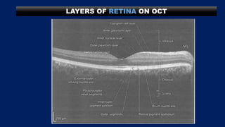 LAYERS OF RETINA ON OCT
 