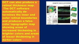 OCT can also produce a
retinal thickness map.
The OCT software
automatically de-
termines the inner and
outer retinal boundaries
and produces a false-
color topographic map
showing areas of
increased thickening in
brighter colors and areas
of lesser thickening in
darker colors
 
