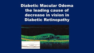 Diabetic Macular Odema
the leading cause of
decrease in vision in
Diabetic Retinopathy
 