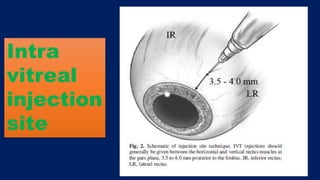 Intra
vitreal
injection
site
 