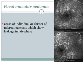 Focal macular oedema:
areas of individual or cluster of
microaneurysms which show
leakage in late phase.
 