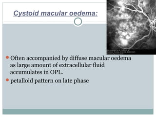 Often accompanied by diffuse macular oedema
as large amount of extracellular fluid
accumulates in OPL.
petalloid pattern on late phase
Cystoid macular oedema:
 