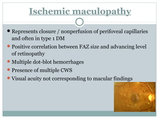 Ischemic maculopathy
Represents closure / nonperfusion of perifoveal capillaries
and often in type 1 DM
Positive correlation between FAZ size and advancing level
of retinopathy
Multiple dot-blot hemorrhages
Presence of multiple CWS
Visual acuity not corresponding to macular findings
 
