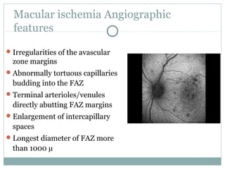 Macular ischemia Angiographic
features
Irregularities of the avascular
zone margins
Abnormally tortuous capillaries
budding into the FAZ
Terminal arterioles/venules
directly abutting FAZ margins
Enlargement of intercapillary
spaces
Longest diameter of FAZ more
than 1000 µ
 