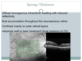 Spongy Thickness
Diffuse homogenous intraretinal swelling with reduced
reflectivity.
fluid accumulation throughout the neurosensory retina.
Confined mainly to outer retinal layers
responds well to laser treatment (focal oedema on FA)
 