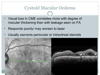 Cystoid Macular Oedema
• Visual loss in CME correlates more with degree of
macular thickening then with leakage seen on FA
• Responds poorly/ may worsen to laser
• Usually warrants periocular or intravitreal steroids
 