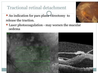 Tractional retinal detachment
An indication for pars plana vitrectomy to
release the traction.
Laser photocoagulation - may worsen the macular
oedema
 
