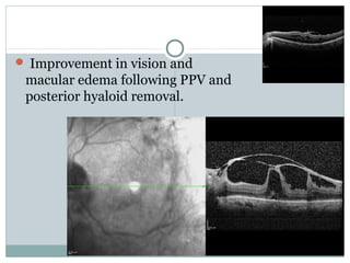  Improvement in vision and
macular edema following PPV and
posterior hyaloid removal.
 