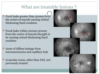 What are treatable lesions ?
 Focal leaks greater than 500um from
the centre of macula causing retinal
thickening/hard exudates.
 Focal leaks within 300um-500um
from the centre of macula thought to
be causing retinal thickening/hard
exudates
 Areas of diffuse leakage from
microaneurysms and capillary leak
 Avascular zones, other than FAZ, not
previously treated.
 