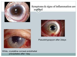 Symptoms & signs of inflammation are
masked
Pseudohypopyon after 2days
White, crystalline corneal endothelial
precipitates after 1day
 