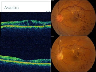 Avastin
 