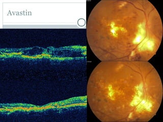 Avastin
 