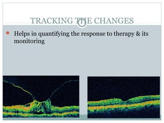 TRACKING THE CHANGES
 Helps in quantifying the response to therapy & its
monitoring
 