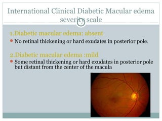 International Clinical Diabetic Macular edema
severity scale
1.Diabetic macular edema: absent
No retinal thickening or hard exudates in posterior pole.
2.Diabetic macular edema :mild
Some retinal thickening or hard exudates in posterior pole
but distant from the center of the macula
 