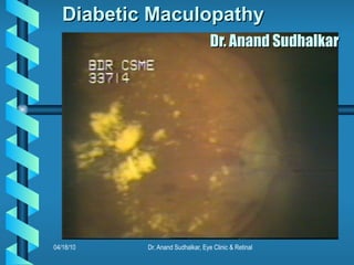 Diabetic Maculopathy    Dr. Anand Sudhalkar 