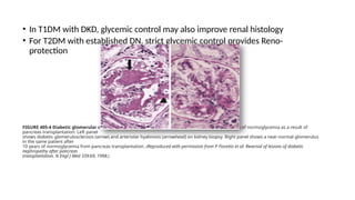 T1dm Panel Diabetic nephropathy for presentation Ager.pptx