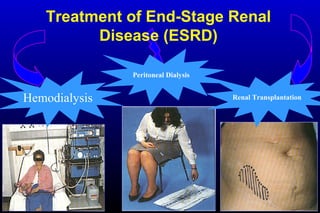 Hemodialysis Renal Transplantation
Peritoneal Dialysis
Treatment of End-Stage Renal
Disease (ESRD)
 