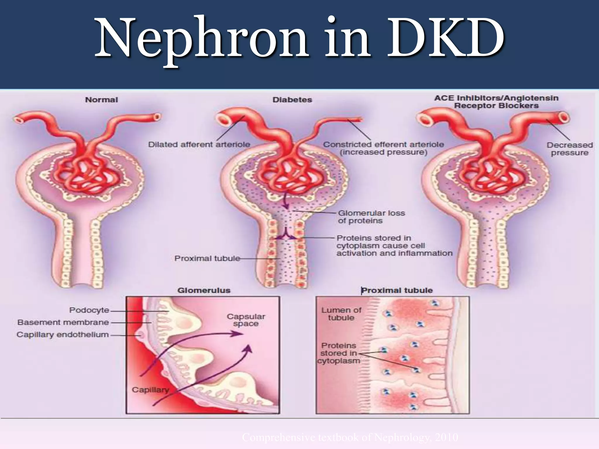 Nephron in DKD
Comprehensive textbook of Nephrology, 2010
 