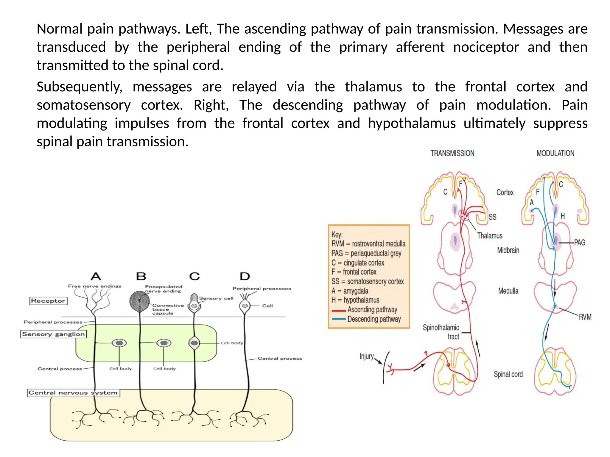 Normal pain pathways. Left, The ascending pathway of pain transmission. Messages are
transduced by the peripheral ending of the primary afferent nociceptor and then
transmitted to the spinal cord.
Subsequently, messages are relayed via the thalamus to the frontal cortex and
somatosensory cortex. Right, The descending pathway of pain modulation. Pain
modulating impulses from the frontal cortex and hypothalamus ultimately suppress
spinal pain transmission.
 