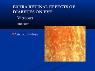 Vitreous
humor
Asteroid hyalosis
EXTRA RETINAL EFFECTS OF
DIABETES ON EYE
 