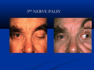 3RD
NERVE PALSY
 