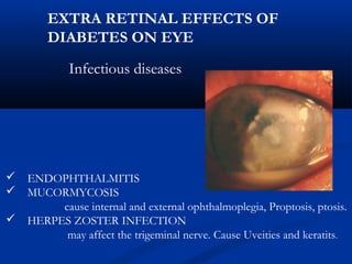 Infectious diseases
 ENDOPHTHALMITIS
 MUCORMYCOSIS
cause internal and external ophthalmoplegia, Proptosis, ptosis.
 HERPES ZOSTER INFECTION
may affect the trigeminal nerve. Cause Uveities and keratits.
EXTRA RETINAL EFFECTS OF
DIABETES ON EYE
 