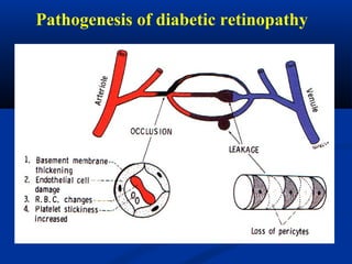 Pathogenesis of diabetic retinopathy
 
