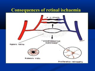 Consequences of retinal ischaemia
 