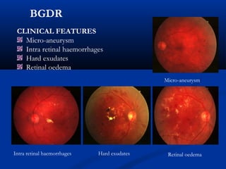 BGDR
CLINICAL FEATURES
Micro-aneurysm
Intra retinal haemorrhages
Hard exudates
Retinal oedema
Micro-aneurysm
Intra retinal haemorrhages Hard exudates Retinal oedema
 