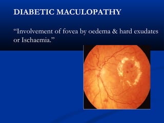 DIABETIC MACULOPATHY
“Involvement of fovea by oedema & hard exudates
or Ischaemia.”
 