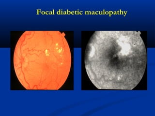 Focal diabetic maculopathy
 