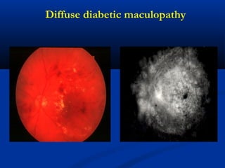 Diffuse diabetic maculopathy
 