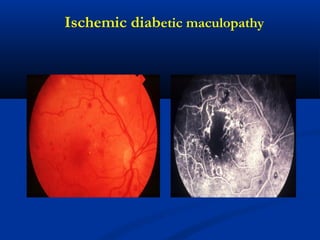Ischemic diabetic maculopathy
 