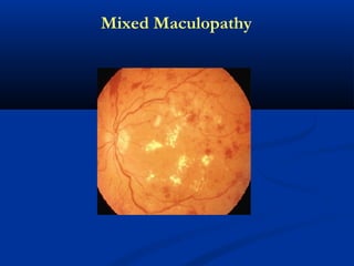 Mixed Maculopathy
 