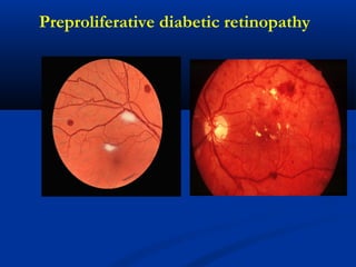 Preproliferative diabetic retinopathy
 