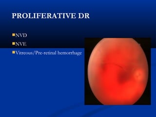 PROLIFERATIVE DR
NVD
NVE
Vitreous/Pre-retinal hemorrhage
 