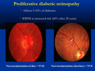 Proliferative diabetic retinopathy
Neovascularization of disc = NVD
• Affects 5-10% of diabetics
• IDDM at increased risk (60% after 20 years)
Neovascularization elsewhere = NVE
 